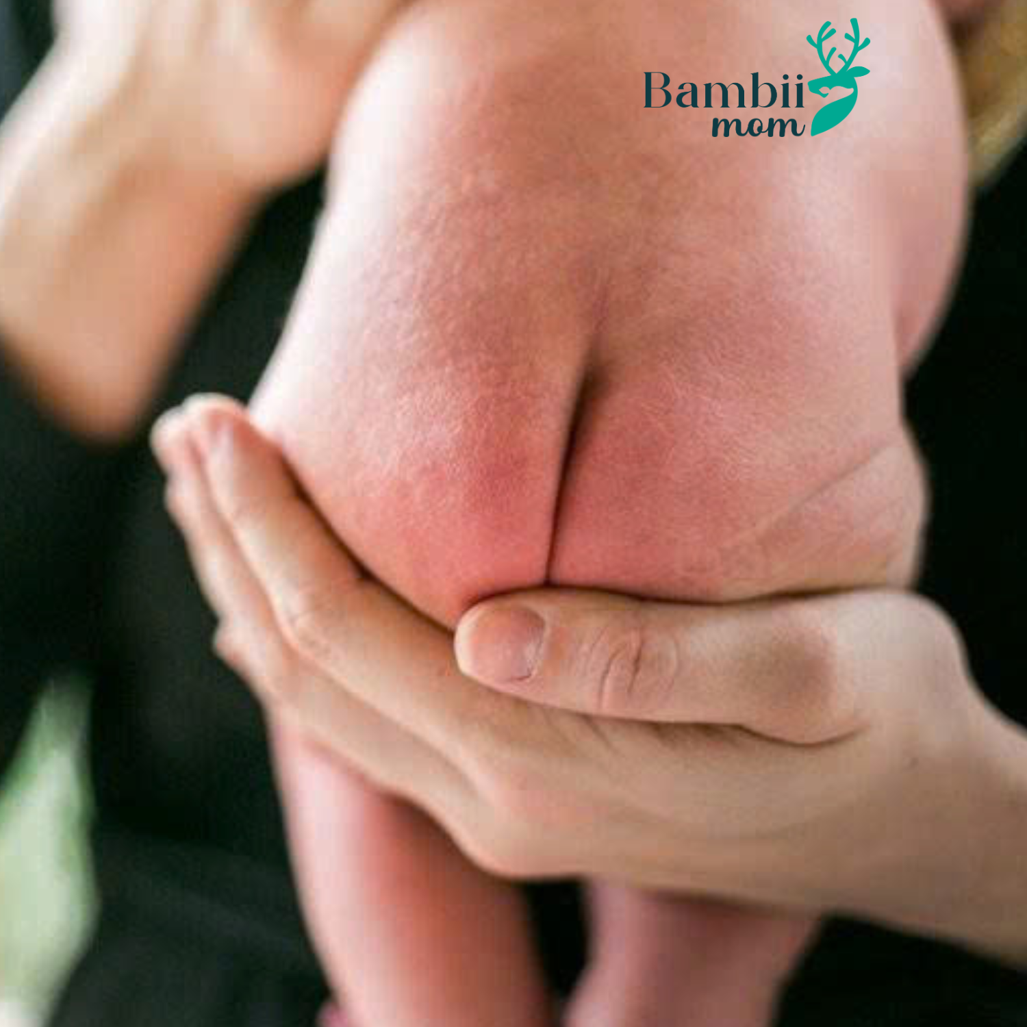 Hăm Tã Bao Lâu Thì Khỏi? Bí Quyết Chăm Sóc Và Ngừa Hăm Tã Hiệu Quả Cho Bé