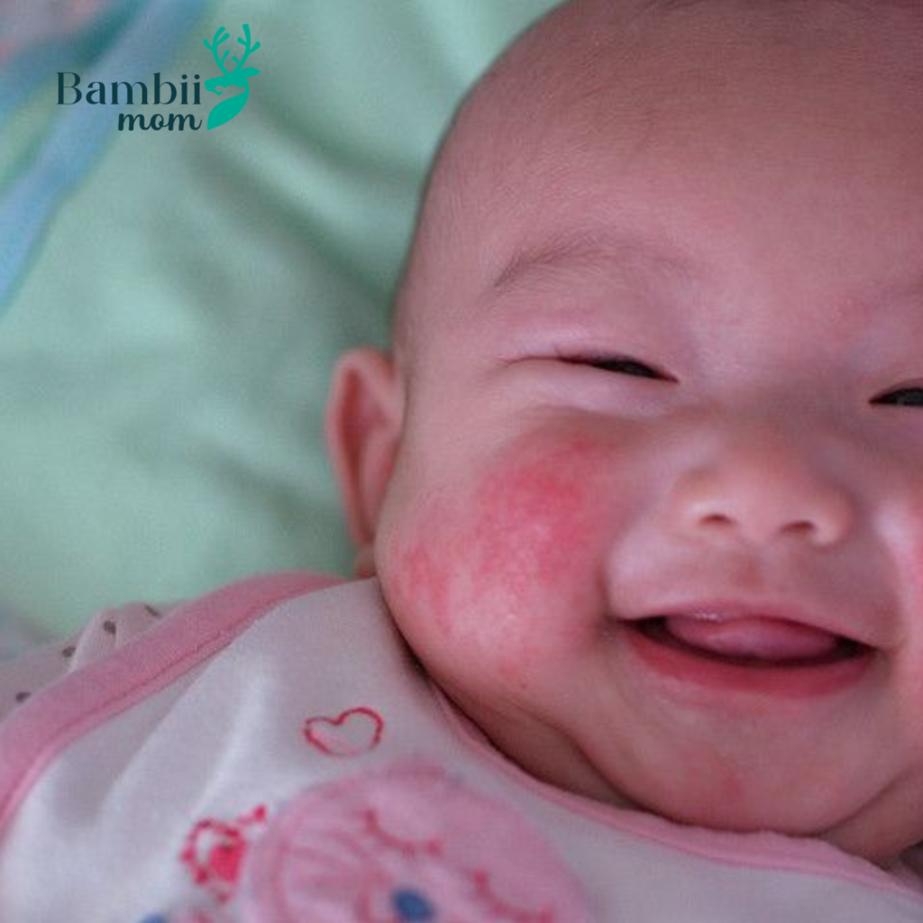 Tình trạng trẻ em bị nổi mẩn đỏ ngứa khắp người khá phổ biến